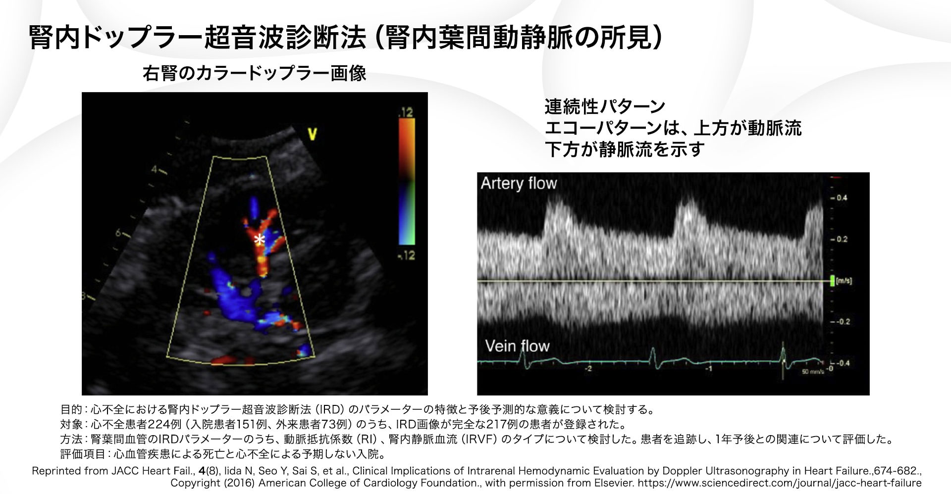 うっ血腎超音波 | 腎動脈血流波形 心不全 – QBPSBG