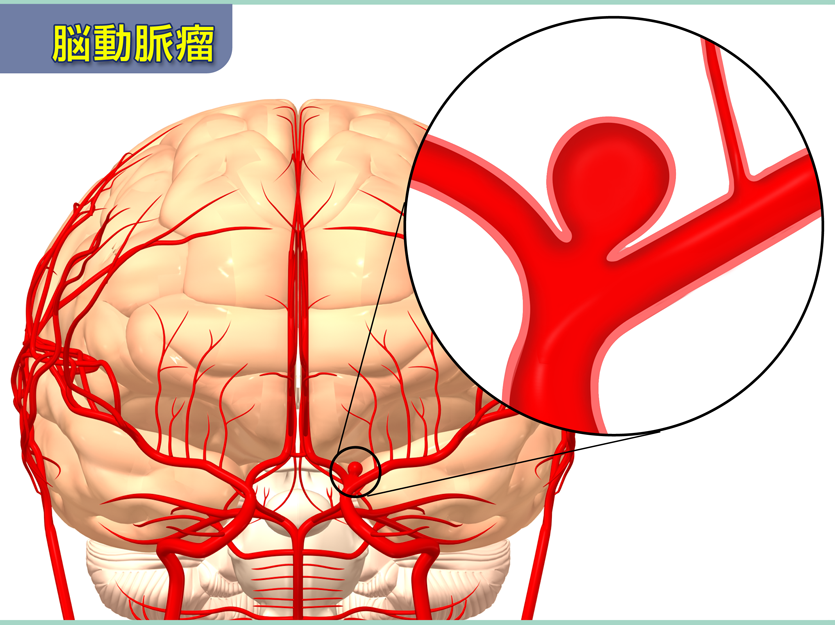 脳動脈瘤