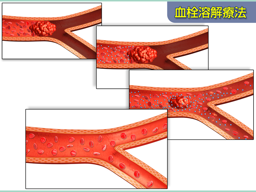 血栓溶解療法