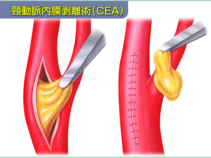 頸動脈内膜剥離術(CEA)