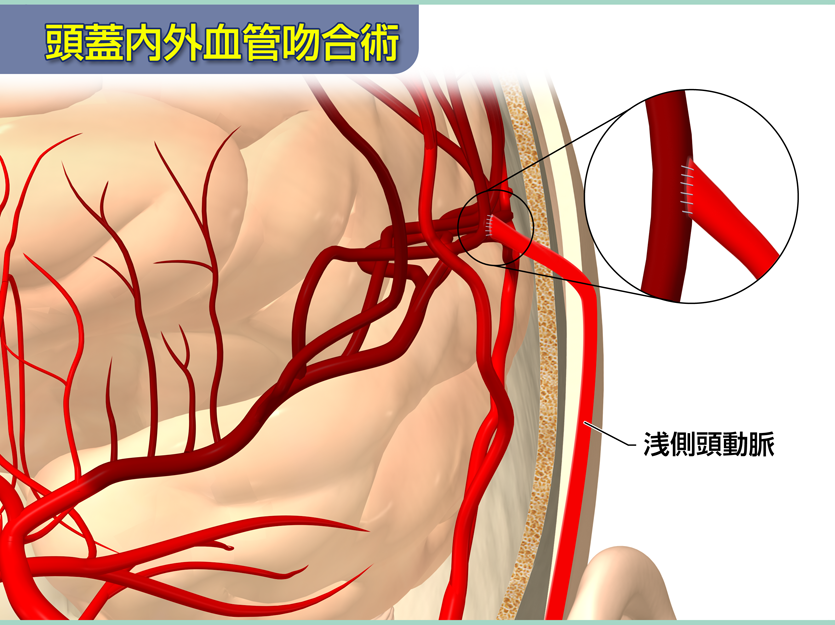 頭蓋内外血管吻合術
