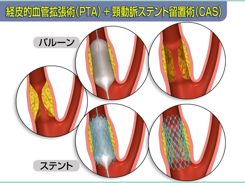 経皮的血管拡張術(PTA)+頸動脈ステント留置術(CAS)
