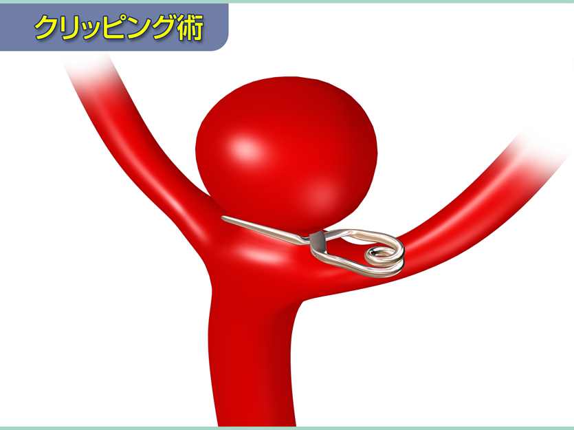 クリッピング術