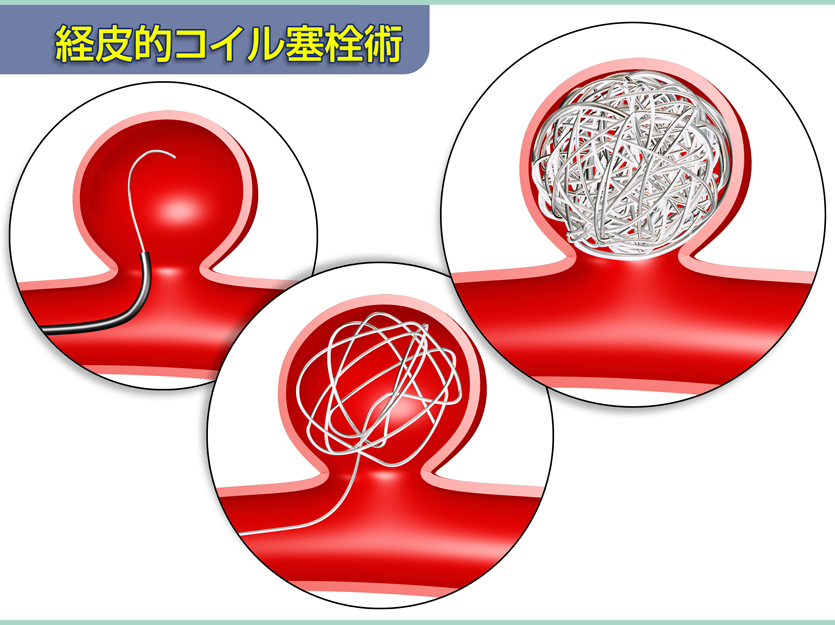 経皮的コイル塞栓術