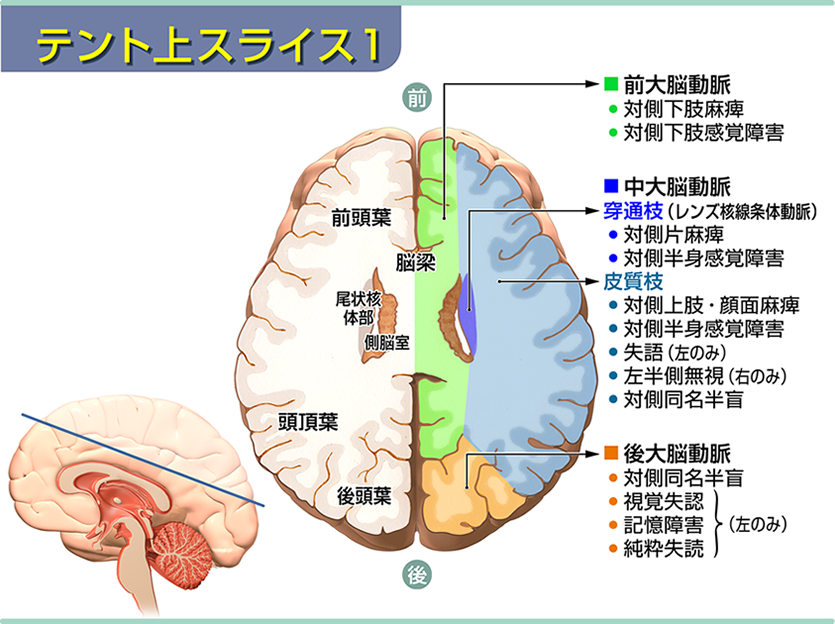 テント上スライス1