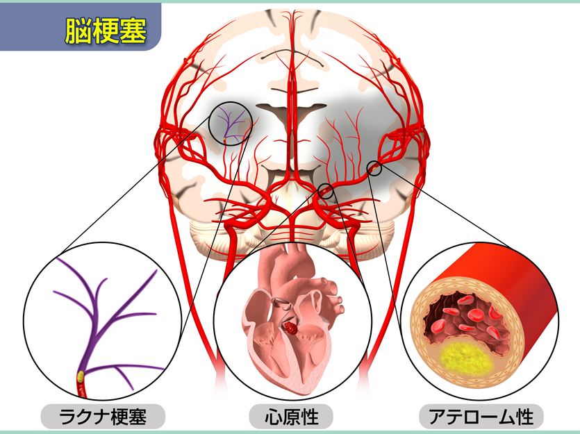 脳梗塞