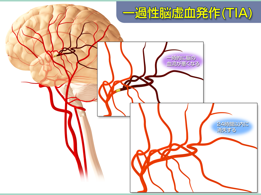 一過性脳虚血発作(TIA)