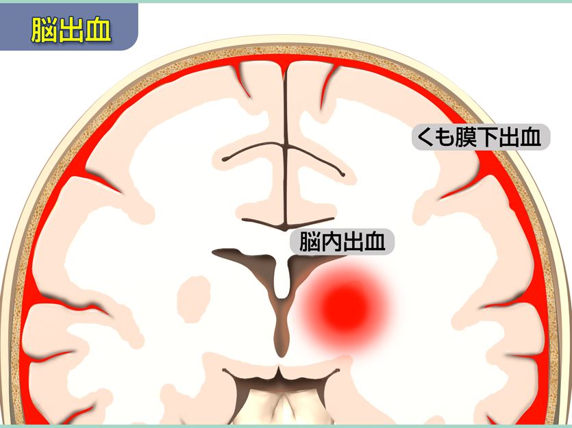 脳出血